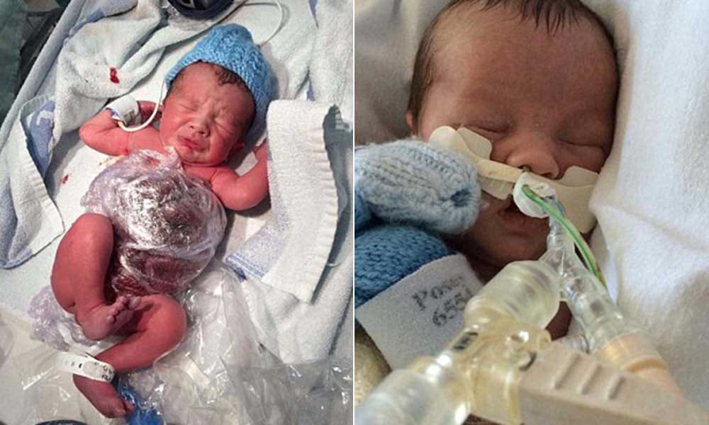 baby born with intestines out suffered 9 operations
