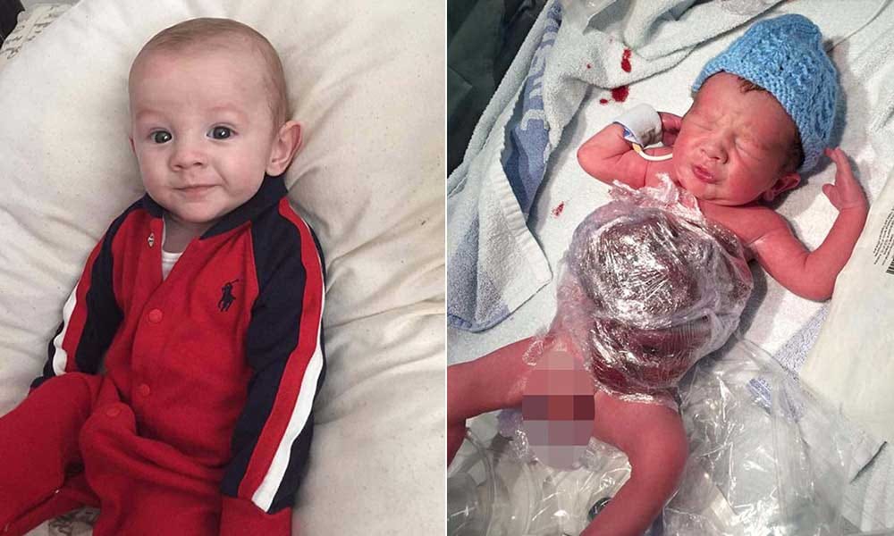 baby born with intestines out suffered 9 operations