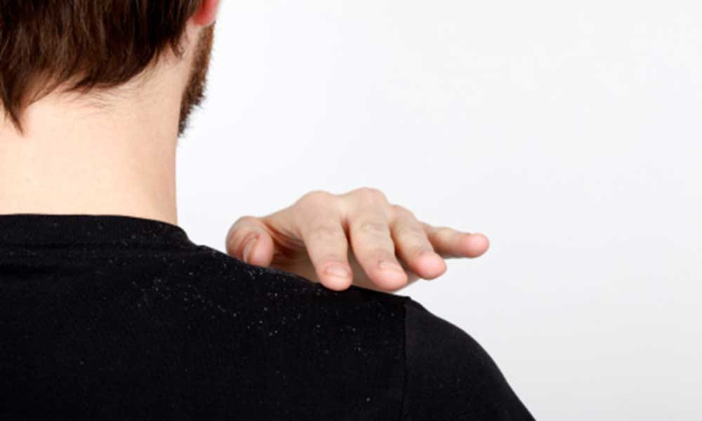 tips for remove dandruff with vinager and aloe vera in hindi