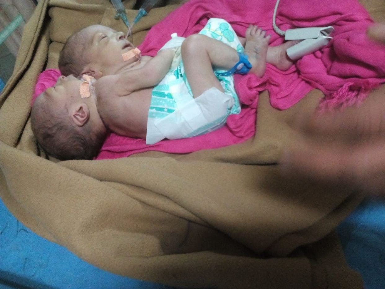 two head new born child admitted in CMI
