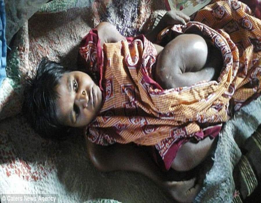 girl suffering from brittle bone disease