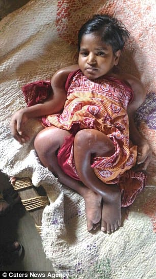 girl suffering from brittle bone disease