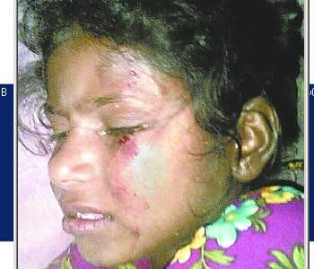 Girl injured in Monkey attack