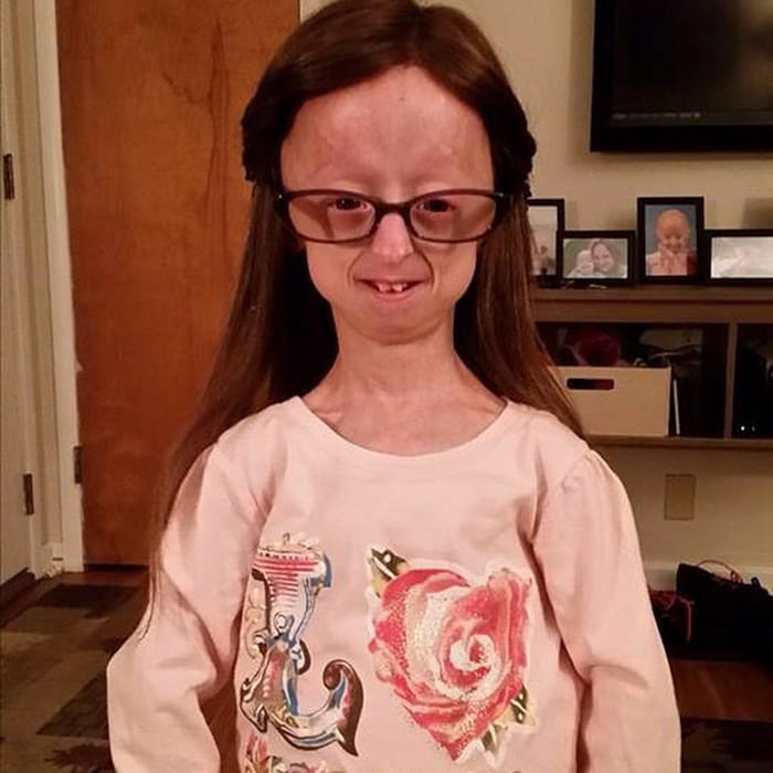 progeria affected girl gets a powerful friend