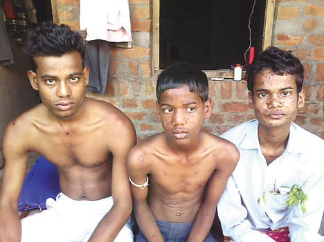 Measles spread in the village, seven sick