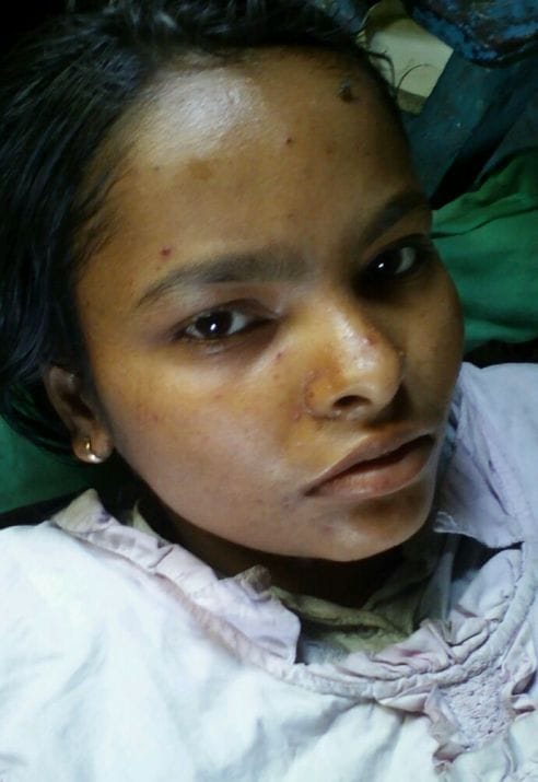 35 ill from measles in Akayapur