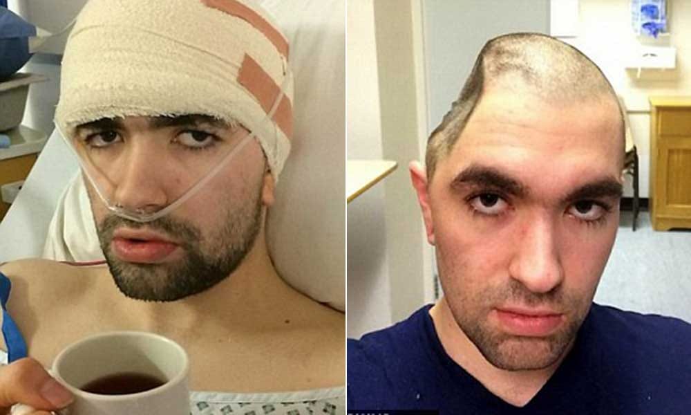 part of skull chopped out to save man's life after he suffered stroke
