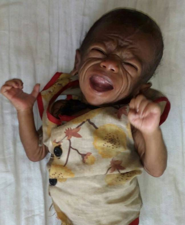 Arckon-clerksHrhua mood malnourished child deaths in the village 