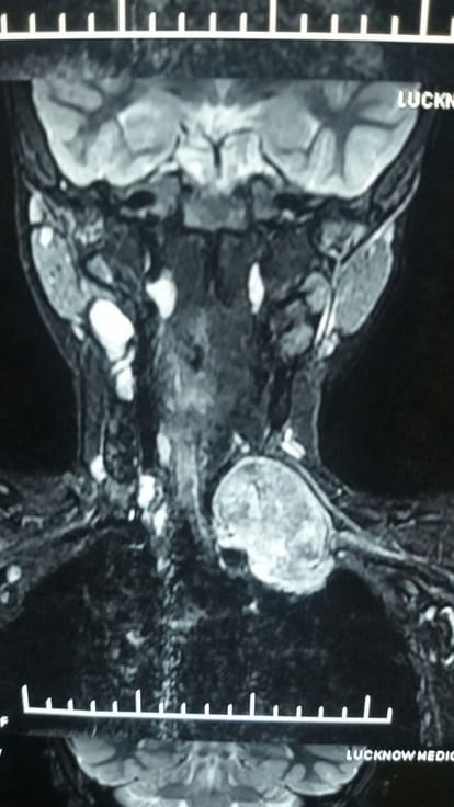 kgmu doctors operated nerve tumor