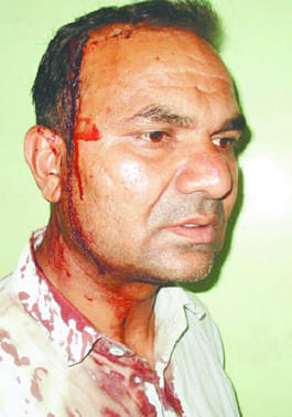 Teacher injured looted cash and phone