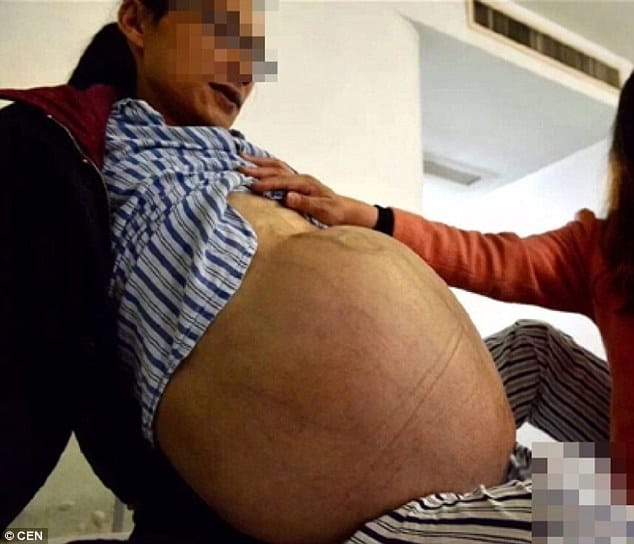 man had 30 kilo of tumour in abdomen, removed