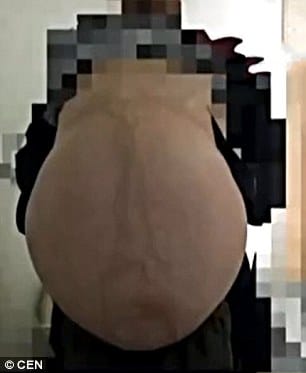man had 30 kilo of tumour in abdomen, removed