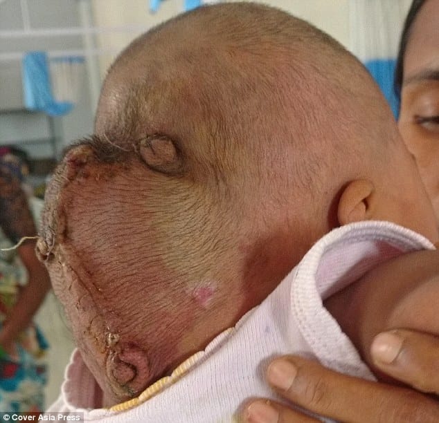 cyst behind head