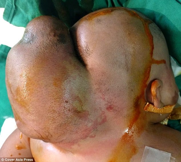 cyst behind head