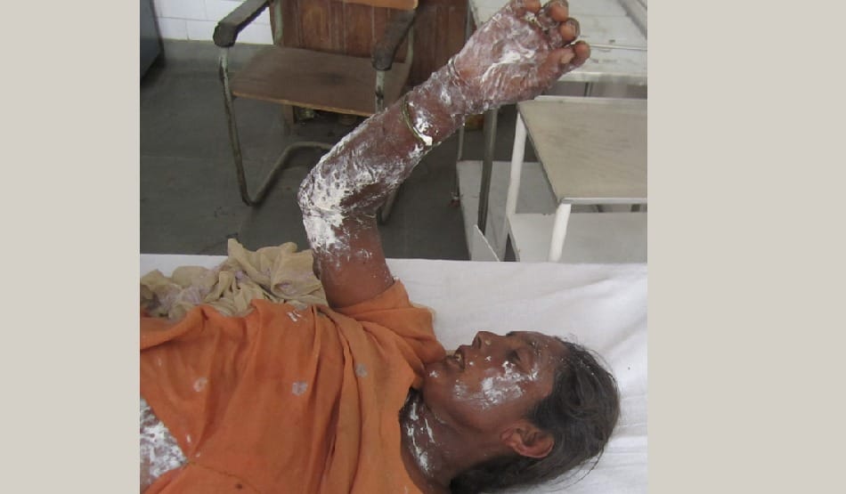 brutal incident: fire on crop of wheat, 4 womens burn in incident in barnala