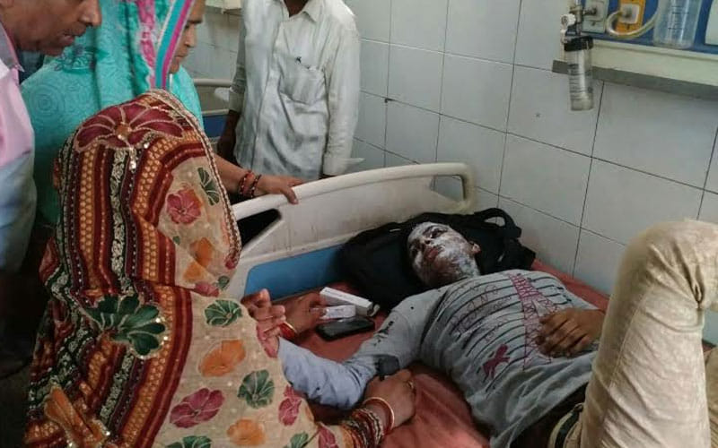 college student's face burned in acid attack in etah up