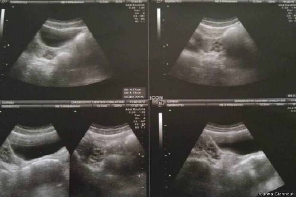 girl without womb cervix vagina