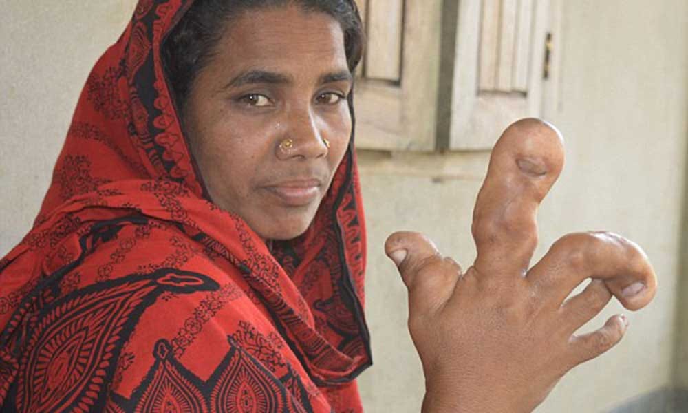 Bangladeshi woman with a football sized palm