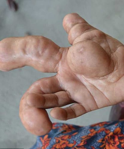 Bangladeshi woman with a football sized palm