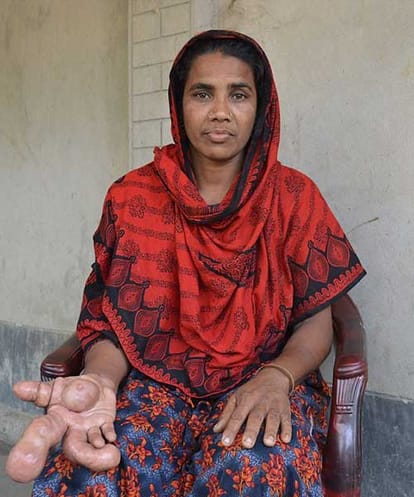 Bangladeshi woman with a football sized palm