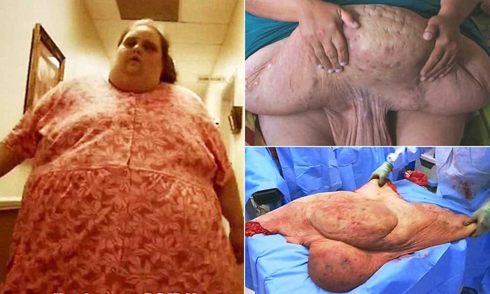 Extra mass removed from woman of 181 kg