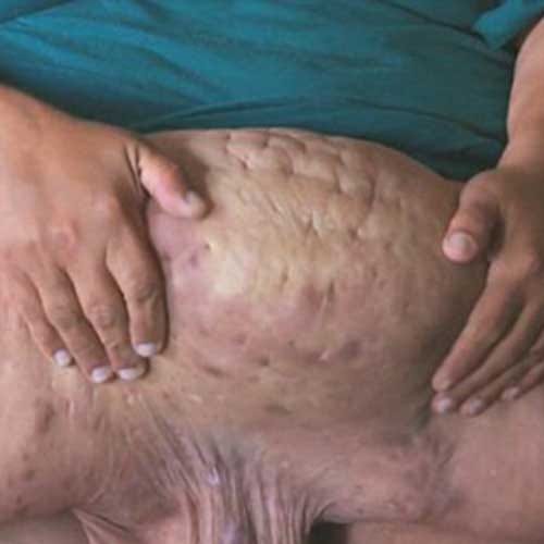 Extra mass removed from woman of 181 kg