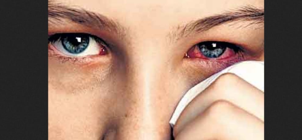 Eye Flu in summer season, use these tips.