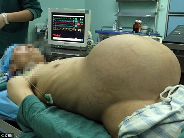 massive tumour removed from man stomach