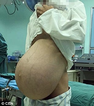 massive tumour removed from man stomach