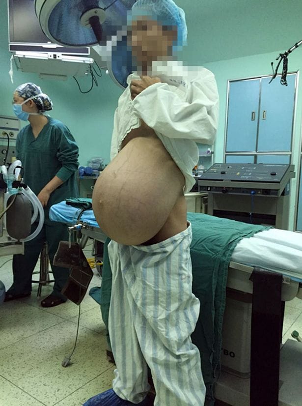 massive tumour removed from man stomach