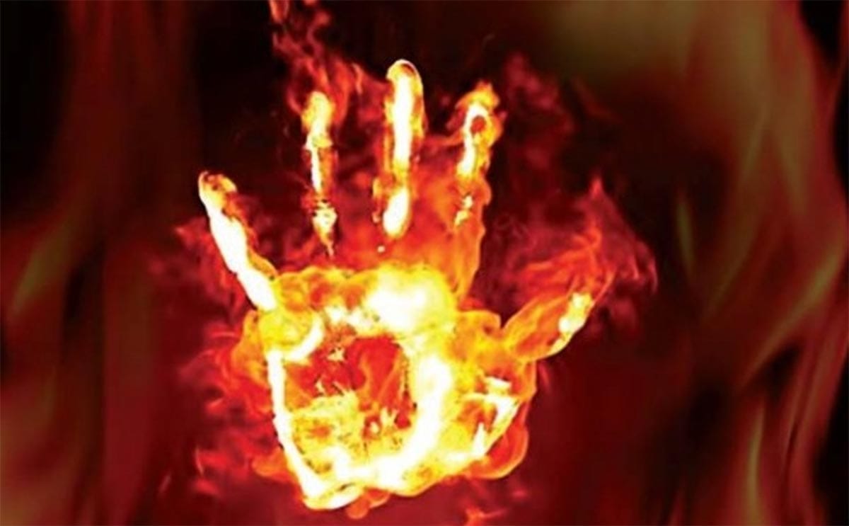 man burned girl in one sided love