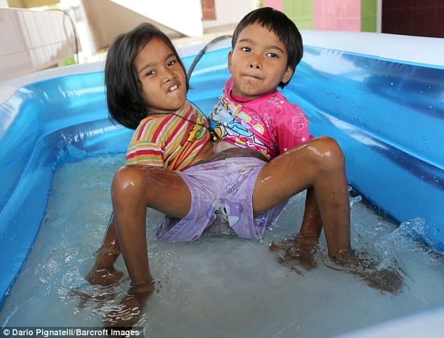 conjoined twins from hips in thailand dont want to get separate