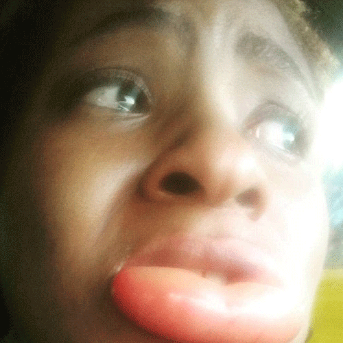lipstick causes swollen of lips