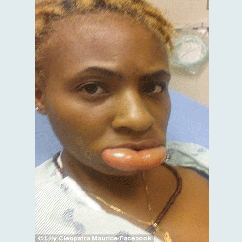 lipstick causes swollen of lips