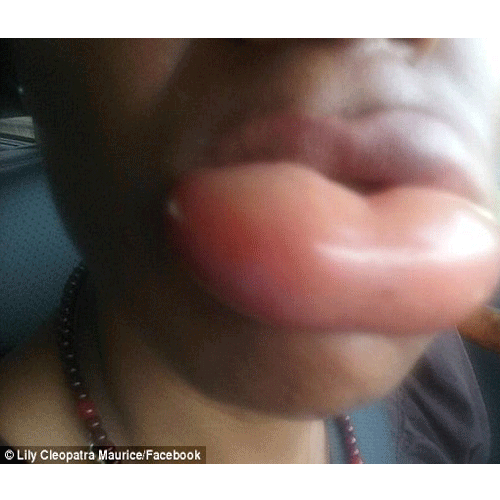 lipstick causes swollen of lips