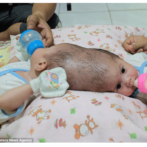 twin girls joined at the head