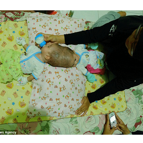 twin girls joined at the head