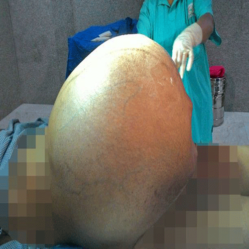 doctors removed 97 kilo ovarian tumor