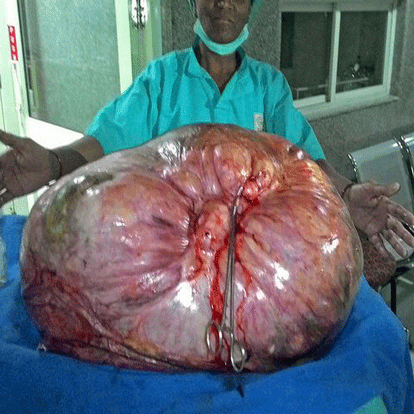 doctors removed 97 kilo ovarian tumor