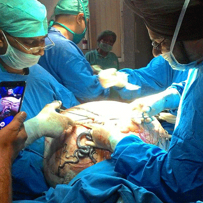 doctors removed 97 kilo ovarian tumor
