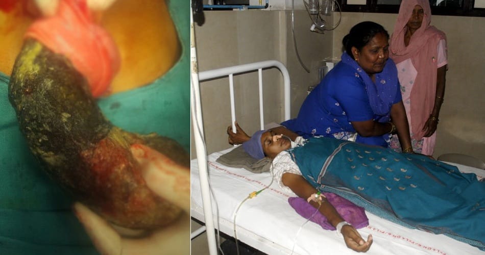 rare surgery of lady stomach after 30 years, bunch of hairs come out, doctors amazed