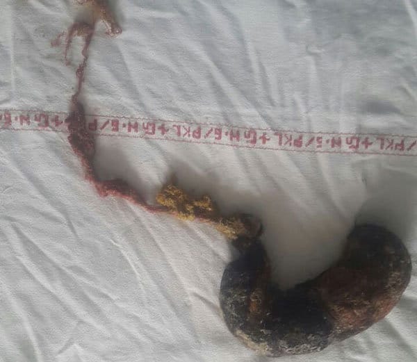 rare surgery of lady stomach after 30 years, bunch of hairs come out, doctors amazed
