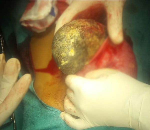 rare surgery of lady stomach after 30 years, bunch of hairs come out, doctors amazed