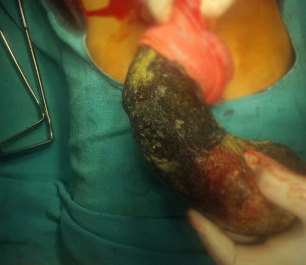 rare surgery of lady stomach after 30 years, bunch of hairs come out, doctors amazed