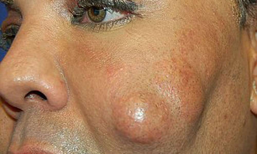 lady with cemented cheeks
