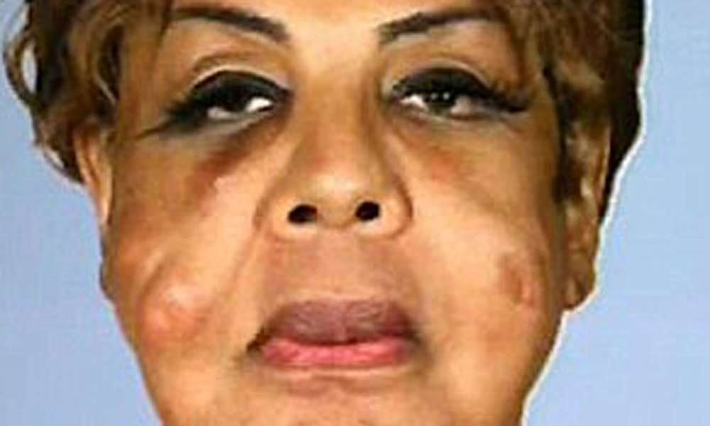 lady with cemented cheeks