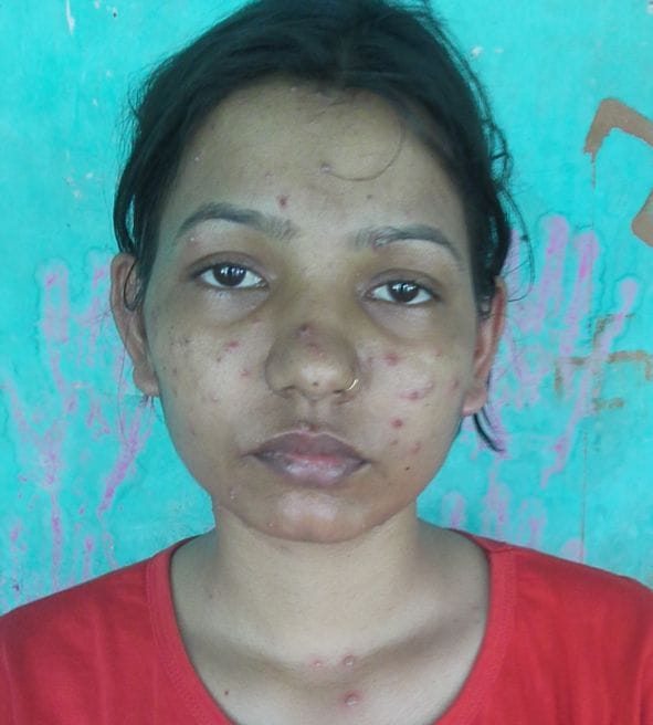 Hundred people in the grip of measles