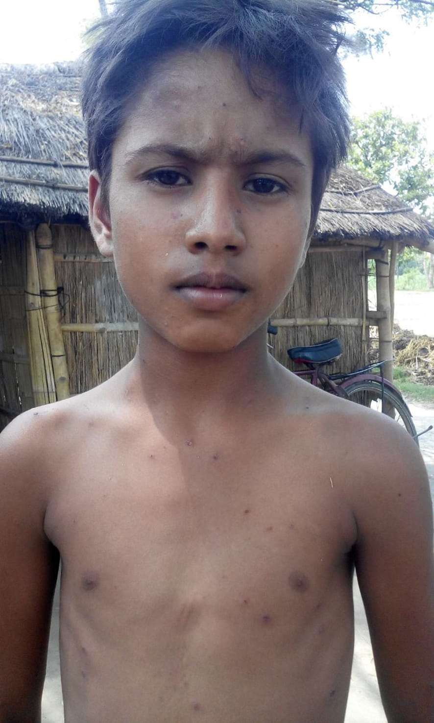  In many villages, people sick with measles
