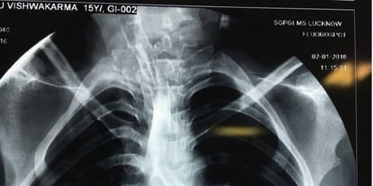 gresto bronkiyal fistual surgery in sgpgi hospital in lucknow