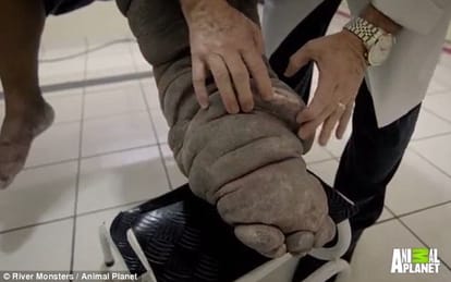 man infected by elephantiasis after bitten by mosquito